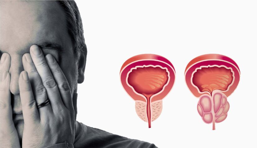 Chronic prostatitis